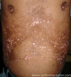 Vitiligo-Graft